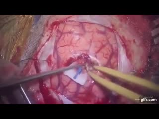 Трепанация черепа, удаление глиобластомы