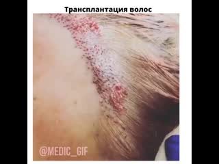 Трансплантация волос