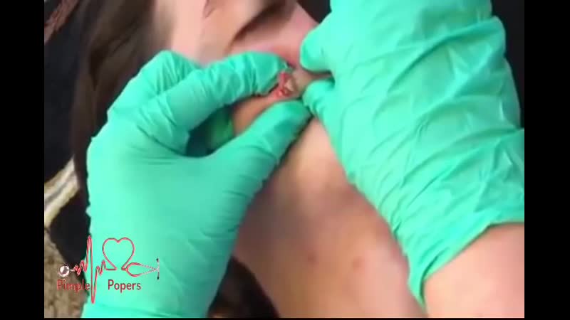 Выдавливание огромной кисты на лице the exorcism of aaron