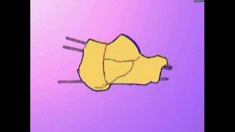 Имплантаты с памятью формы при плоскостопии и переломах пяточной кости