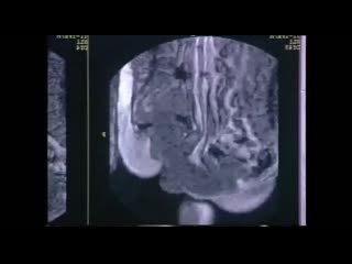 Секс через аппарат мрт