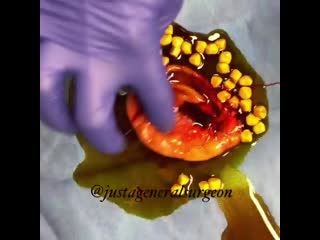 Желчный пузырь с камнями