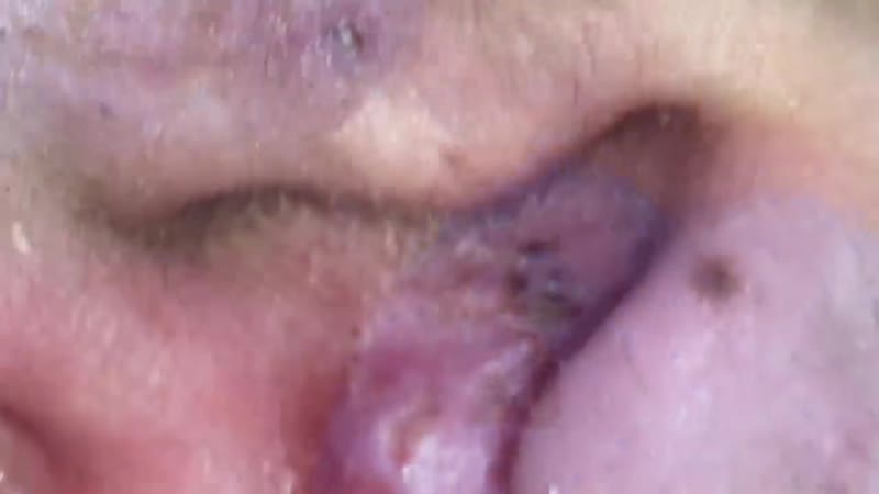 Огромные черные точки в ухе, чистка лица