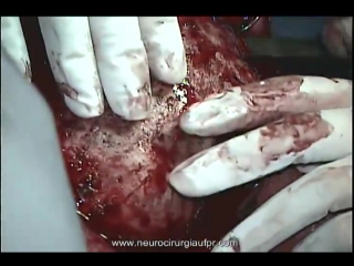 57 трепанация при эпидуральной гематоме