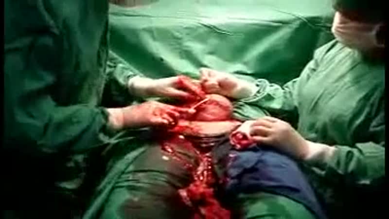 Кесарево сечение