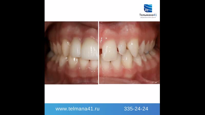 Протезирование винирами e max