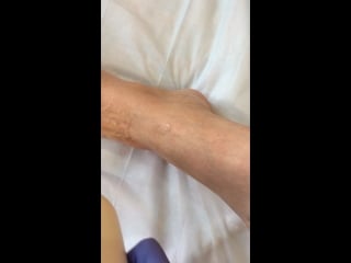 Эпиляция элос