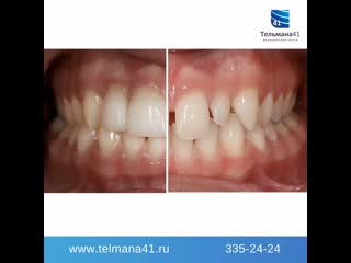 Протезирование винирами e max