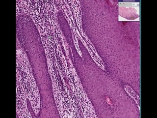 Penis chancres in syphilis