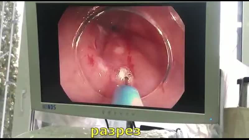 Резекция слизистой желудка лоскутным методом (emr)