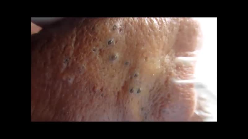 Огромные черные точки на носу и щеках, комедоны