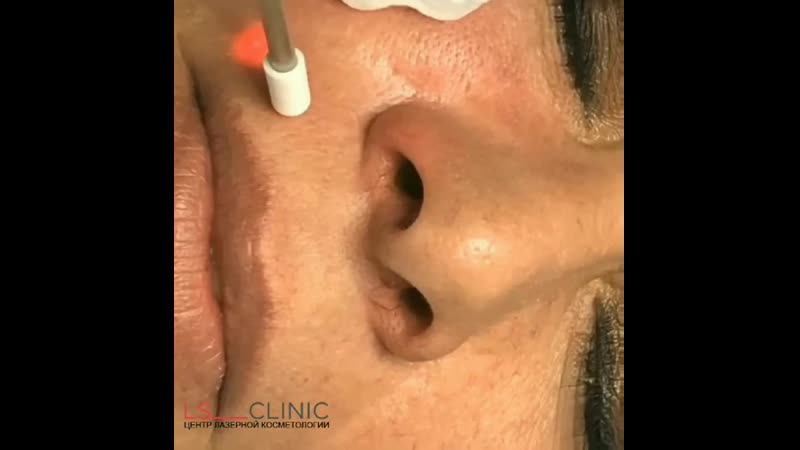 Лазерное удаление сосудов в "ls clinic" балашиха