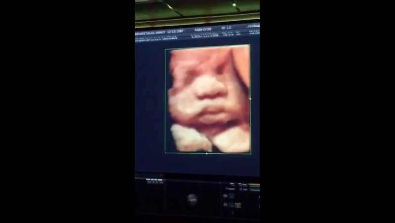 Zoe porn video – Live 4d ultrasound of my son aaron zoe here at hi mom 4d baby ultrasound!
