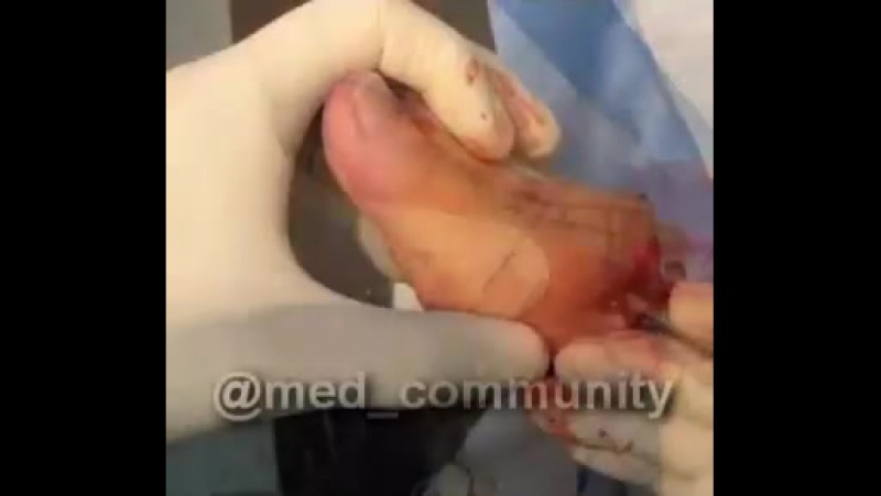 Хирургическое лечение вальгусной деформации, вследствие которой развился бурсит большого пальца стопы