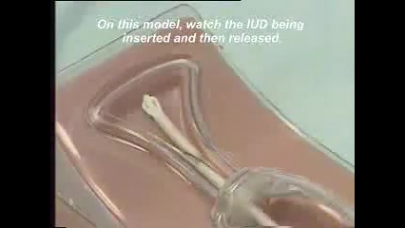 Устаноа внутриматочной спирали