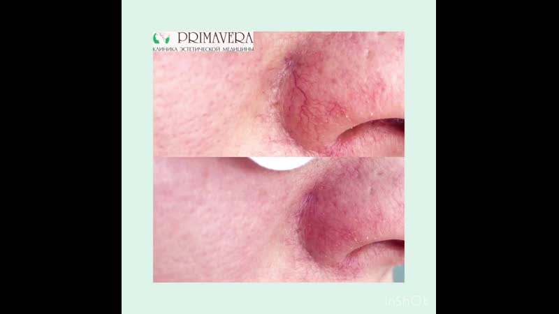 Примавера удаление сосудов до и посое