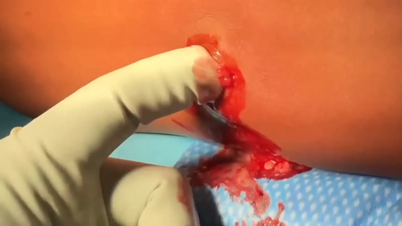 Инфекция из за раны от когтей кота