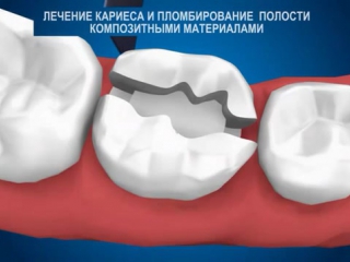 Лечение карие и пломбирование компазитными материалами