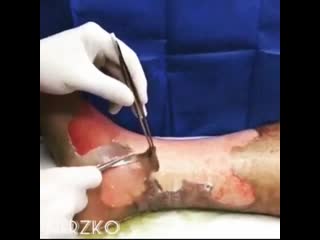 Ожог 3 степени