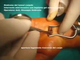 55 декомпрессия срединного нерва (карпальный синдром) 2