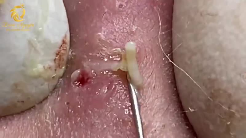 Черные точки, угри, воспаленные прыщи