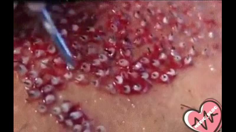 Трансплантация волос