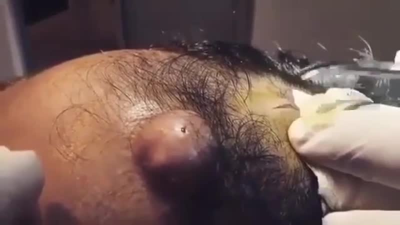 Кисты porn video – Удаление сальной кисты