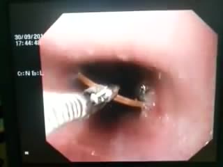 Удаление монеты из пищевода ребенка