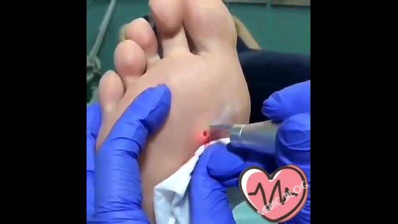 Удаление подошвенной бородаи