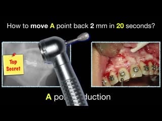 Gummy smile aao 2019 part