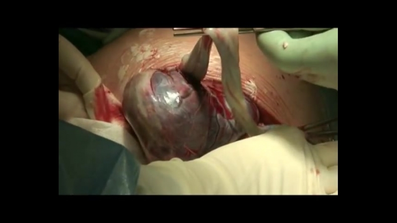 Кесарево сечение по штарку с аргоноплазменной коагуляцией