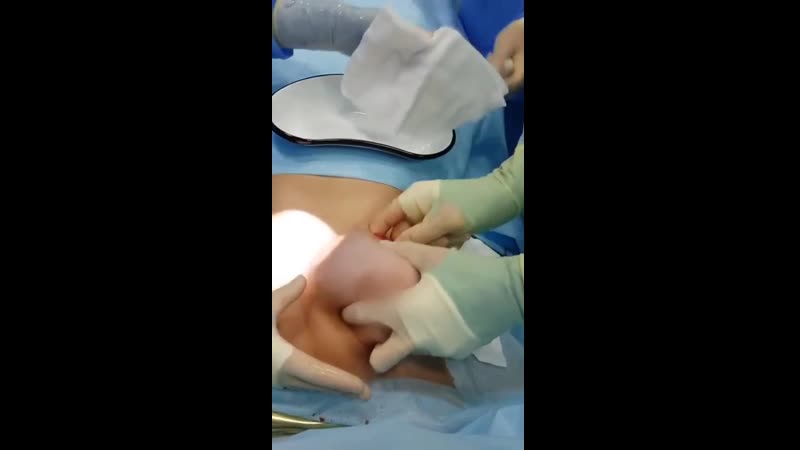 Удаление грудного импланта с комментированием процесса