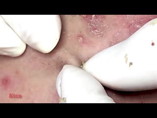 Выдавливание мелких черных точек