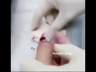 Удаление гематомы под ногтем