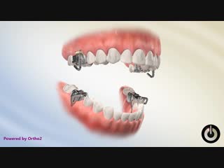 Mara dental braces ортодонтия