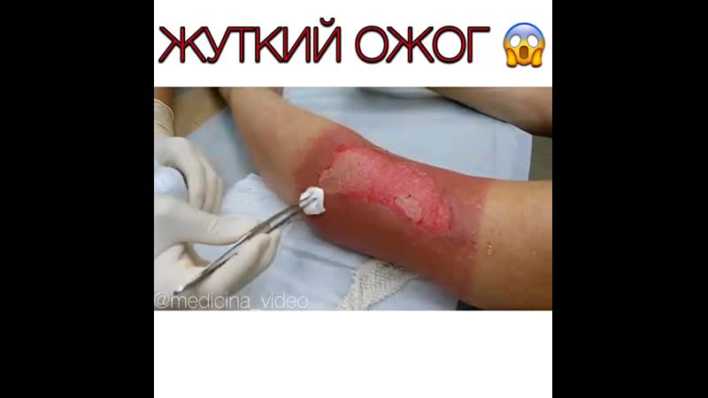 Жуткий ожог 🔥