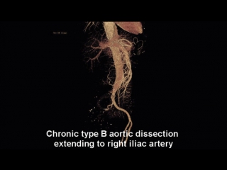 Open aaa repair in a patient with chronic type b aortic dissection and increasin