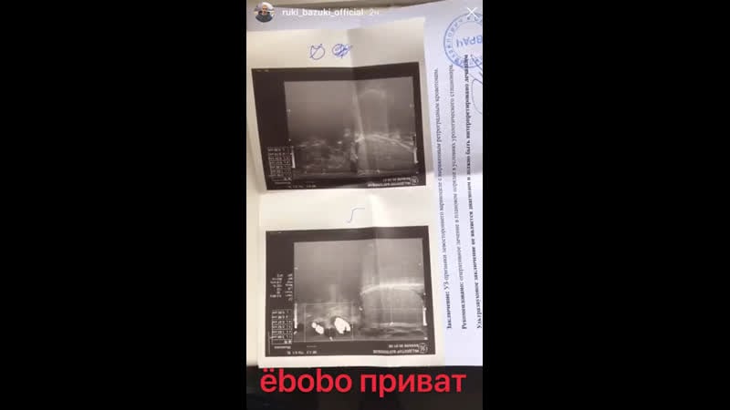 Онкология, варикоцеле, суицид?