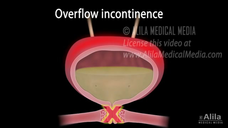 Urinary incontinence in women, //