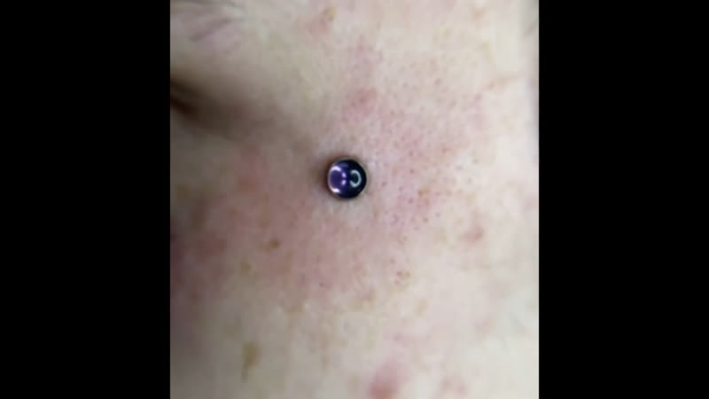 Устаноа микродермала