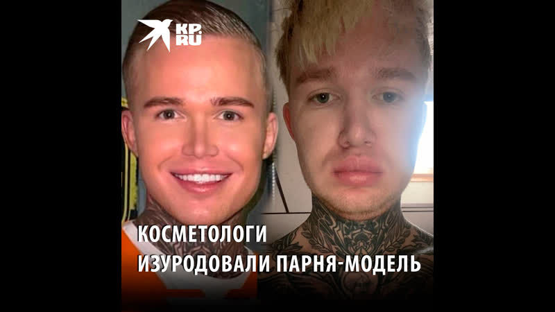 Косметологи изуродовали парня модель