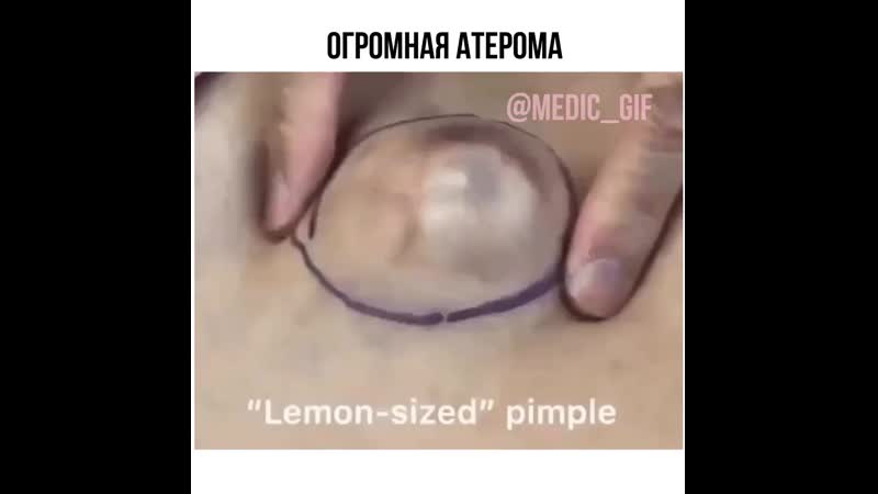 Удаление жировика (1080p) mp4