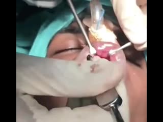 Ортогнатическая медицина передняя верхнечелюстная остеотомия