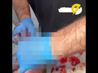 Замглавы администрации буйнакска лишился части руки после молодые гранаты