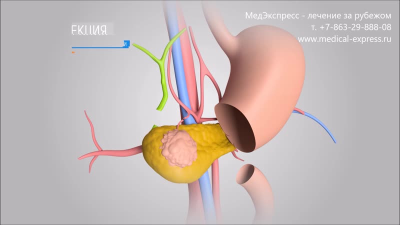 Хирургическое лечение рака поджелудочной железы в германии медэкспресс лечение за рубежом