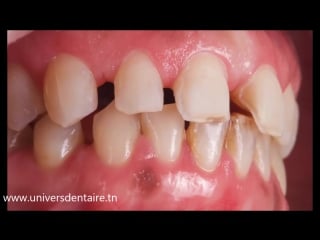 Veneers for diastema closing