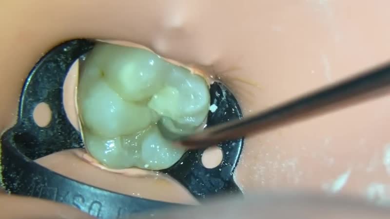 Прямая реставрация