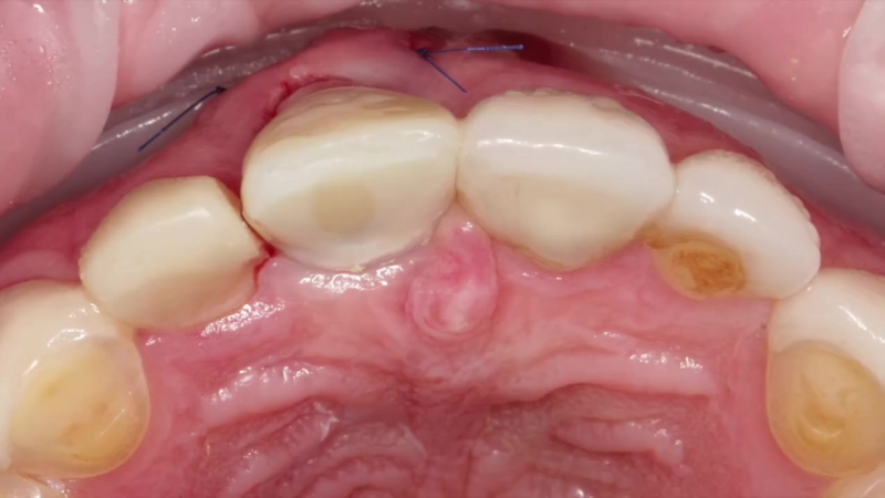 Имплантация немедленная нагрузка nobel biocare