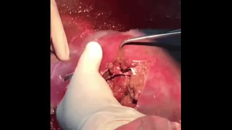 Наложение швов на печень