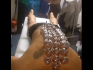 Cupping therapy